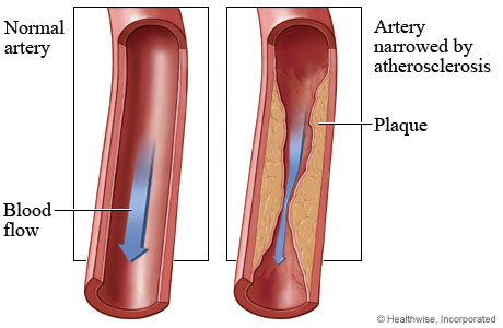 how plaque builds up in the walls of arteries...