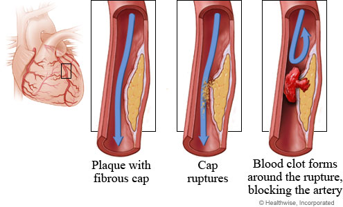 clogged arteries leading to heart disease